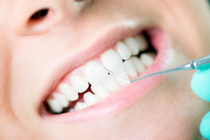 Preventing Gum Disease
