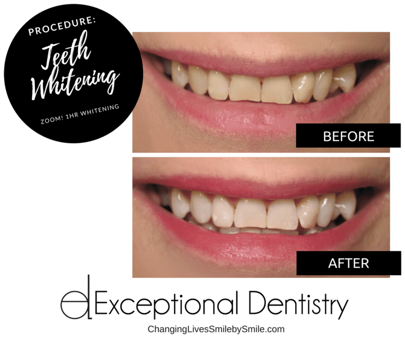 before after whitening