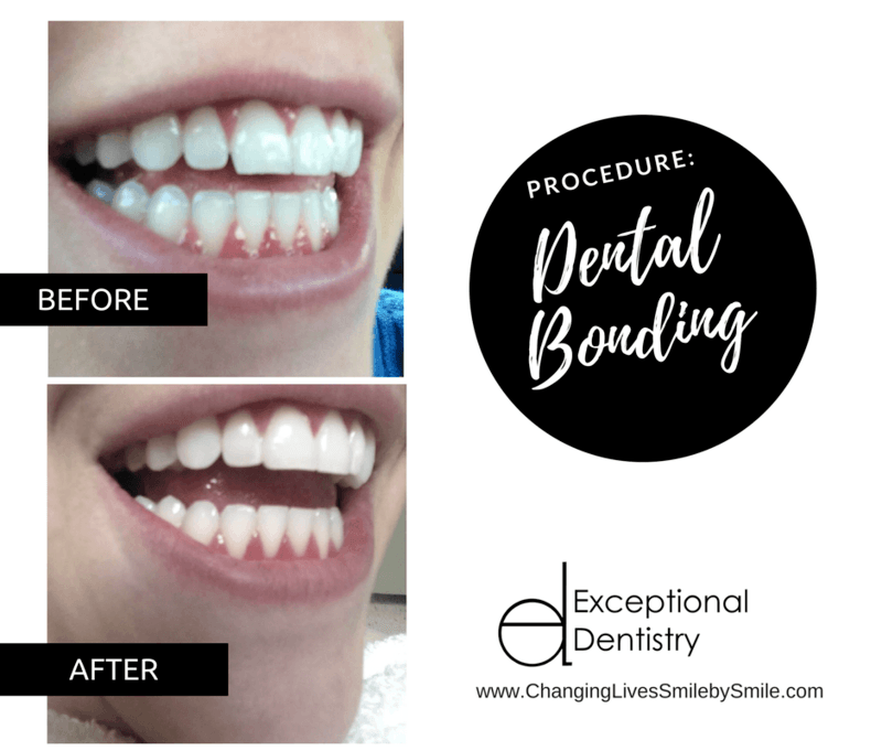 Dental Bonding B&A